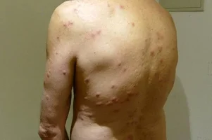 alergicka reakcia stipance plostica